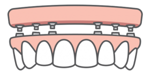 Illustration of an All-on-4 full-arch dental implant-supported bridge and how it fits onto four dental implants